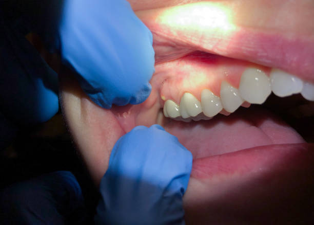 Best Emergency Gum Treatment in Cokato, MN